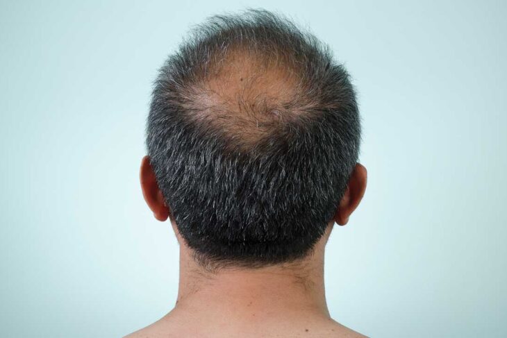 What is Scalp Micropigmentation Manchester and how SMP Manchester can help?