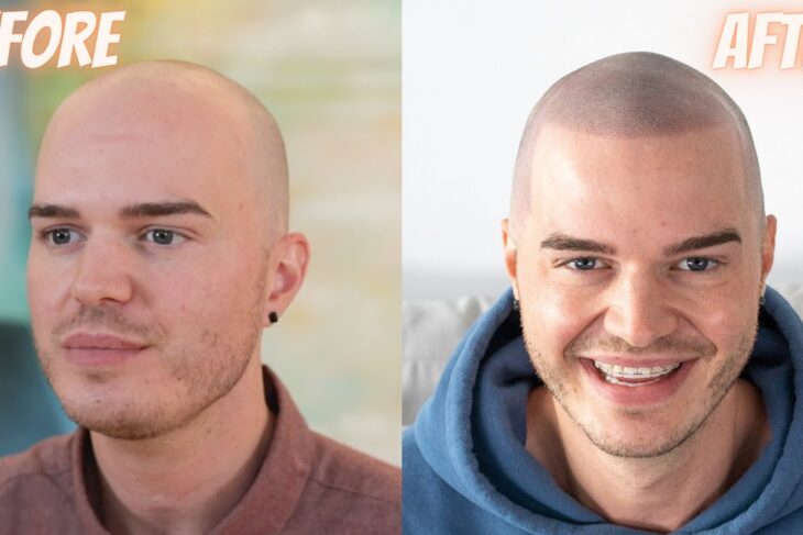What are the different types of male pattern hair loss: Scalp Micropigmentation Birmingham?