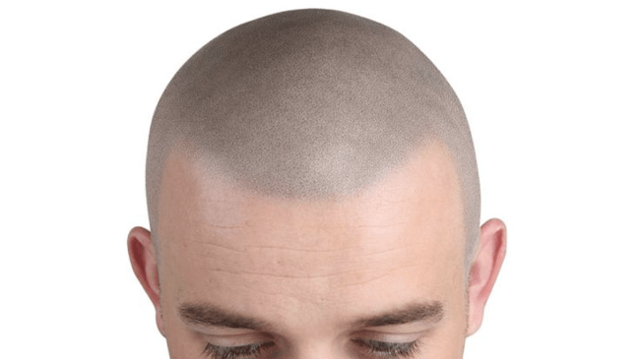 What is Scalp Micropigmentation or SMP and its related popular questions?